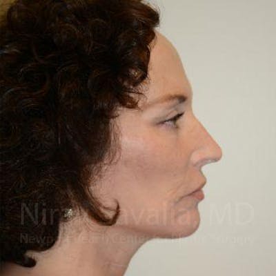 Facelift Before & After Gallery - Patient 1655712 - After1