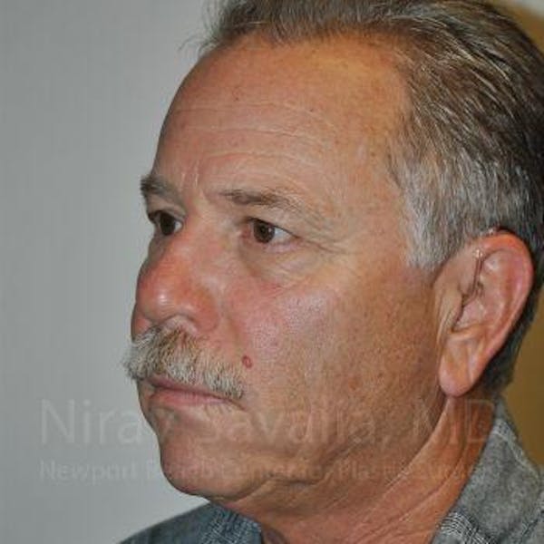 Eyelid Surgery Before & After Gallery - Patient 1655711 - Before1