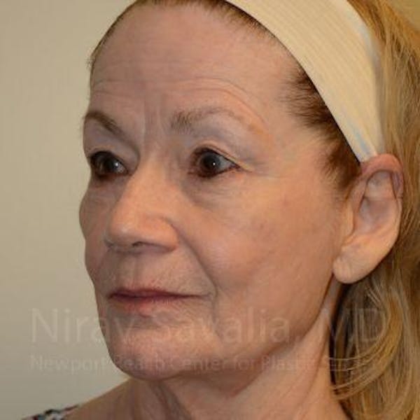 Fat Grafting to Face Before & After Gallery - Patient 1655710 - Before1