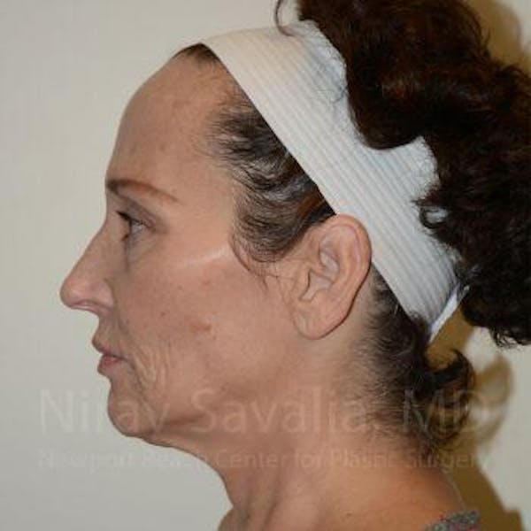 Facelift Before & After Gallery - Patient 1655712 - Before1