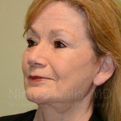 Fat Grafting to Face Before & After Gallery - Patient 1655710 - After1