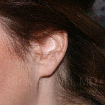 Torn Earlobe Repair Ear Gauge Repair Before & After Gallery - Patient 1655713 - After1