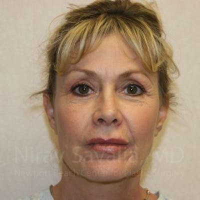 Eyelid Surgery Before & After Gallery - Patient 1655714