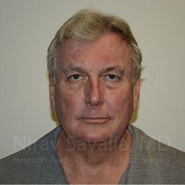 Facelift Before & After Gallery - Patient 1655717 - Before1