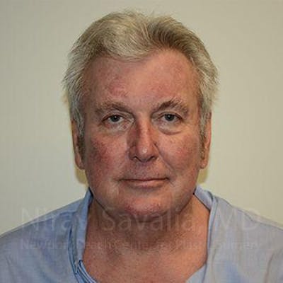 Facelift Before & After Gallery - Patient 1655717 - After1