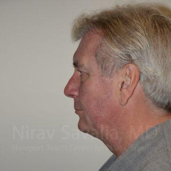 Facelift Before & After Gallery - Patient 1655717 - Before1