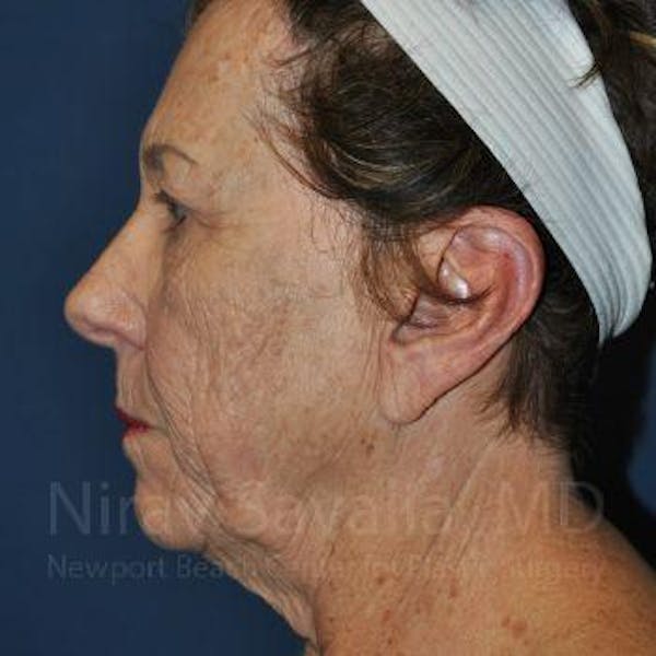 Fat Grafting to Face Before & After Gallery - Patient 1655716 - Before1