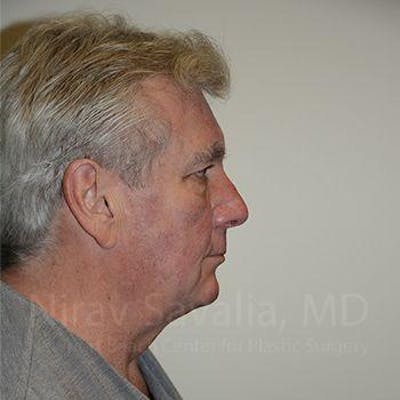 Facelift Before & After Gallery - Patient 1655717 - Before1