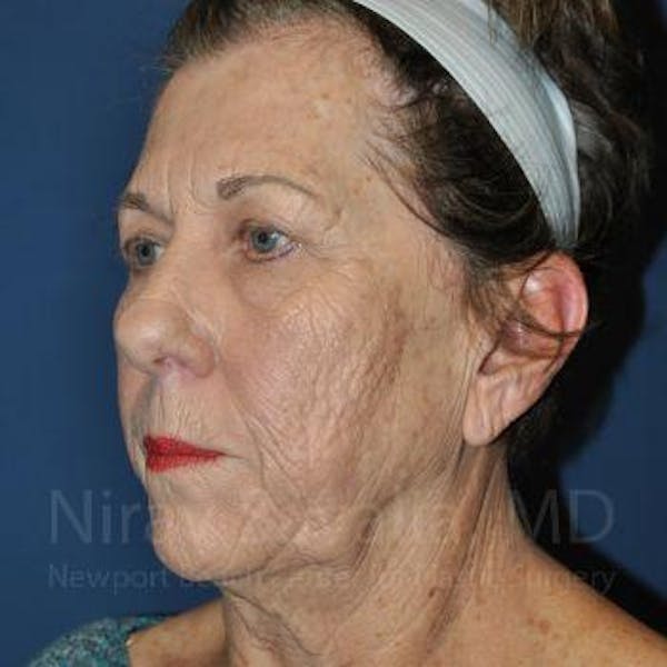 Fat Grafting to Face Before & After Gallery - Patient 1655716 - Before1