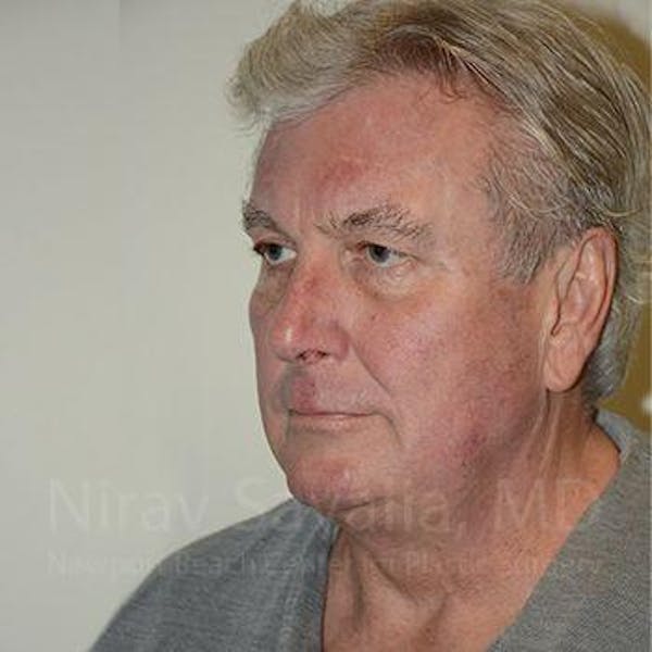 Facelift Before & After Gallery - Patient 1655717 - Before1