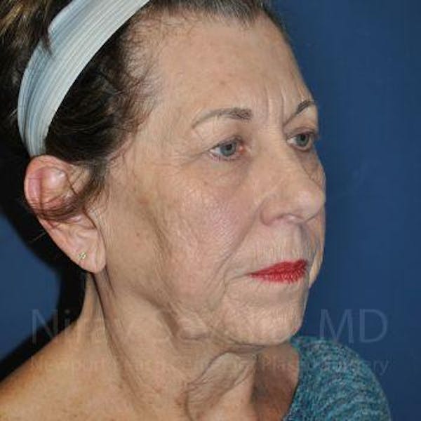 Fat Grafting to Face Before & After Gallery - Patient 1655716 - Before1