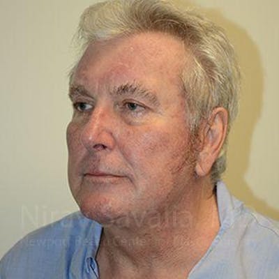 Facelift Before & After Gallery - Patient 1655717 - After1
