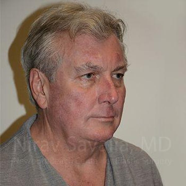 Facelift Before & After Gallery - Patient 1655717 - Before1