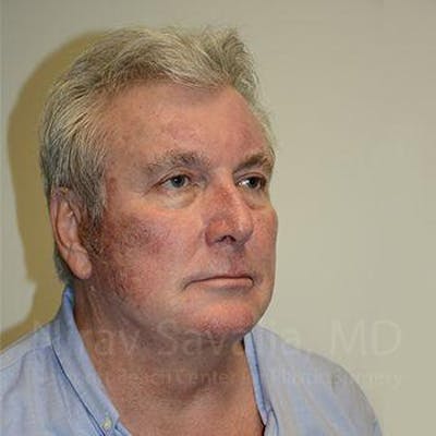 Facelift Before & After Gallery - Patient 1655717 - After1