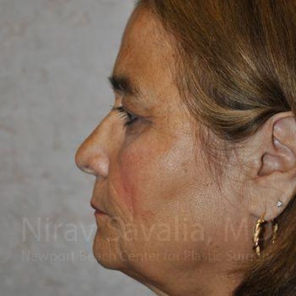Eyelid Surgery Before & After Gallery - Patient 1655719 - Before1