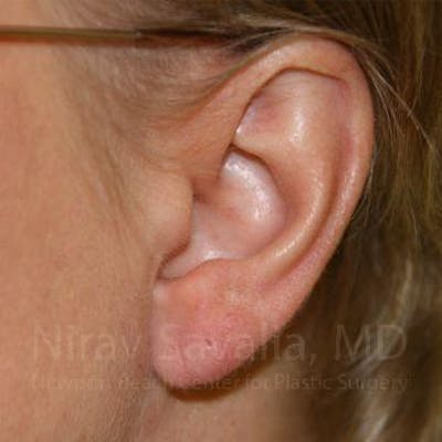 Torn Earlobe Repair Ear Gauge Repair Before & After Gallery - Patient 1655718