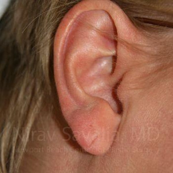 Torn Earlobe Repair Ear Gauge Repair Before & After Gallery - Patient 1655718 - Before1