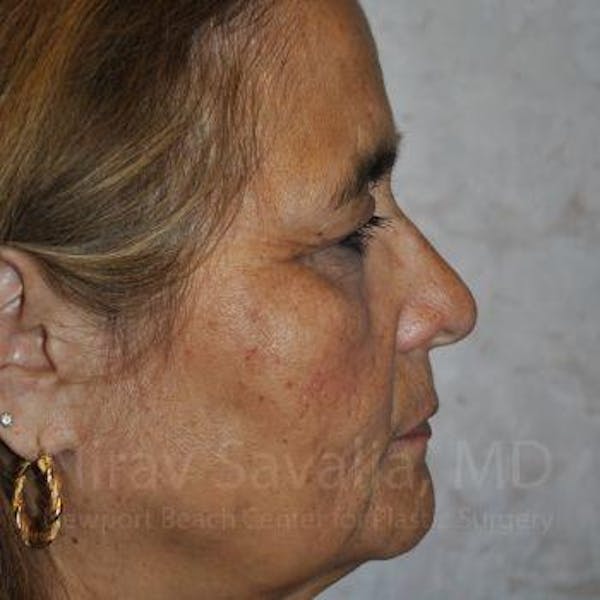 Eyelid Surgery Before & After Gallery - Patient 1655719 - Before1