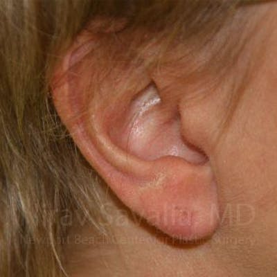 Torn Earlobe Repair Ear Gauge Repair Before & After Gallery - Patient 1655718 - After1