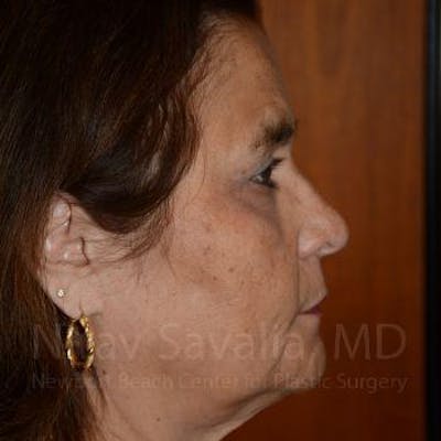 Eyelid Surgery Before & After Gallery - Patient 1655719 - After1