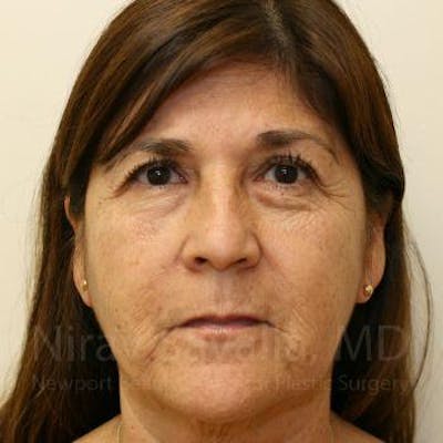 Facelift Before & After Gallery - Patient 1655721 - After1