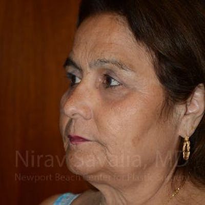 Eyelid Surgery Before & After Gallery - Patient 1655719 - After1