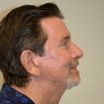 Fat Grafting to Face Before & After Gallery - Patient 1655720 - After1