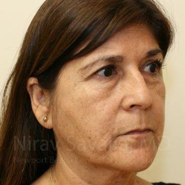 Facelift Before & After Gallery - Patient 1655721 - Before1
