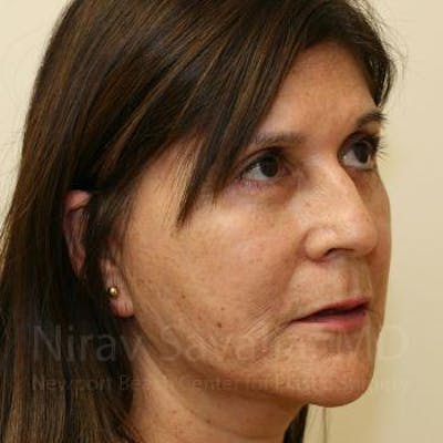 Facelift Before & After Gallery - Patient 1655721 - After1