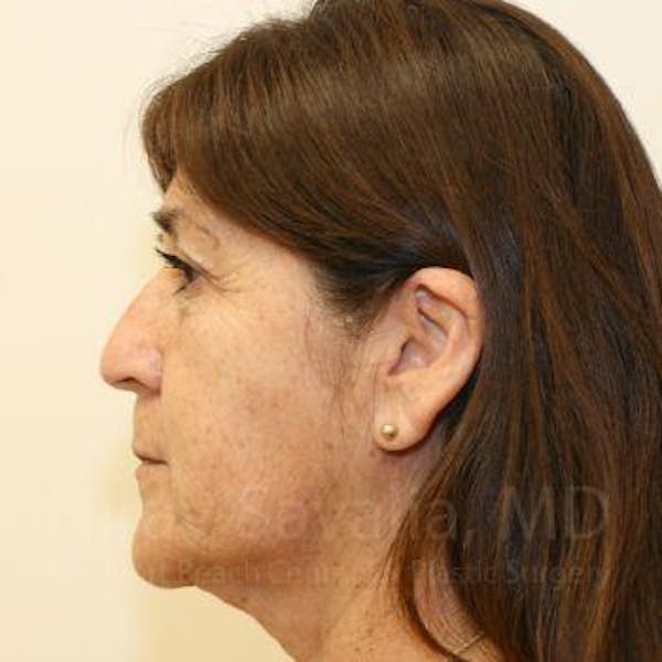 Facelift Before & After Gallery - Patient 1655721 - Before1