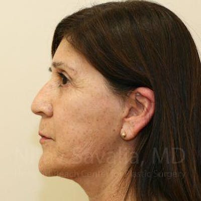 Facelift Before & After Gallery - Patient 1655721 - After1