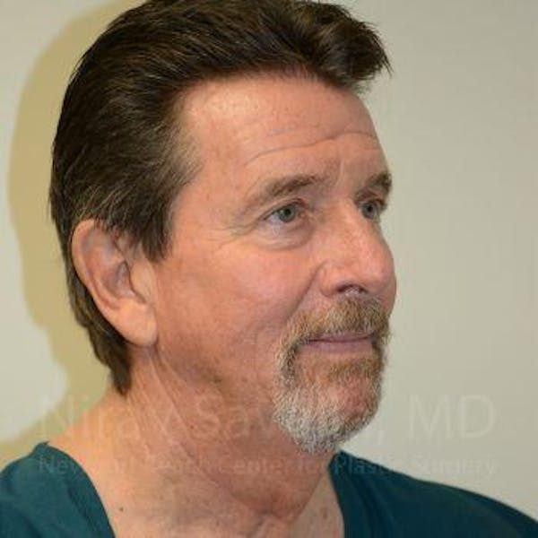 Fat Grafting to Face Before & After Gallery - Patient 1655720 - Before1