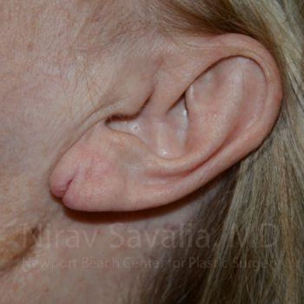 Torn Earlobe Repair Ear Gauge Repair Before & After Gallery - Patient 1655722 - Before1