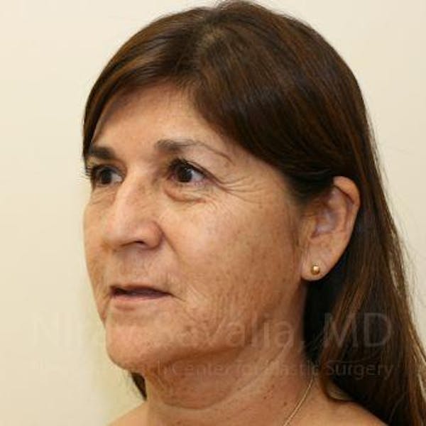Facelift Before & After Gallery - Patient 1655721 - Before1