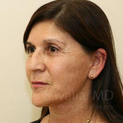Facelift Before & After Gallery - Patient 1655721 - After1