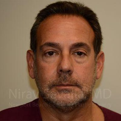 Eyelid Surgery Before & After Gallery - Patient 1655723