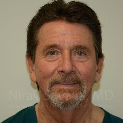 Facelift Before & After Gallery - Patient 1655726 - After1