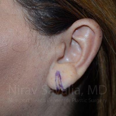 Torn Earlobe Repair Ear Gauge Repair Before & After Gallery - Patient 1655724