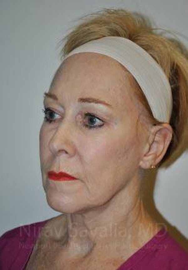 Fat Grafting to Face Before & After Gallery - Patient 1655725 - Before1