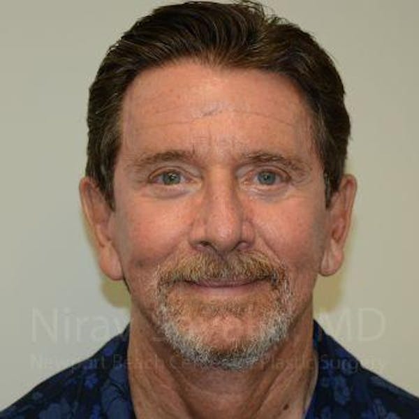Facelift Before & After Gallery - Patient 1655726 - Before1