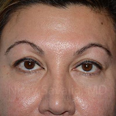 Eyelid Surgery Before & After Gallery - Patient 1655728
