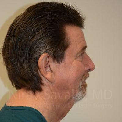 Facelift Before & After Gallery - Patient 1655726 - Before1