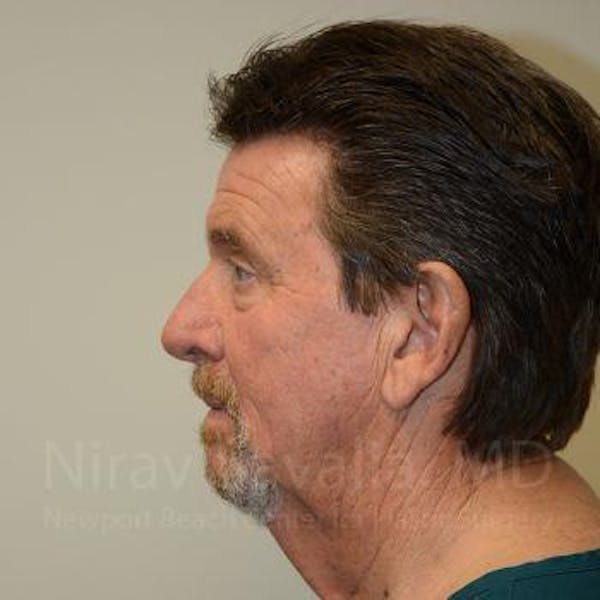 Facelift Before & After Gallery - Patient 1655726 - Before1