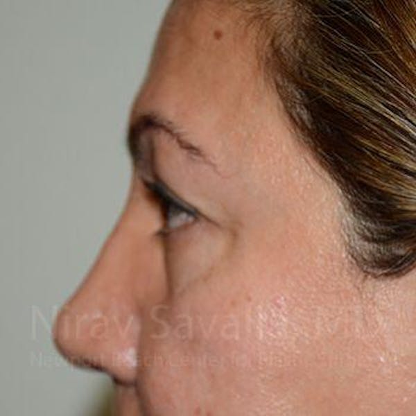 Eyelid Surgery Before & After Gallery - Patient 1655728 - Before1