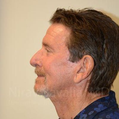 Facelift Before & After Gallery - Patient 1655726 - After1