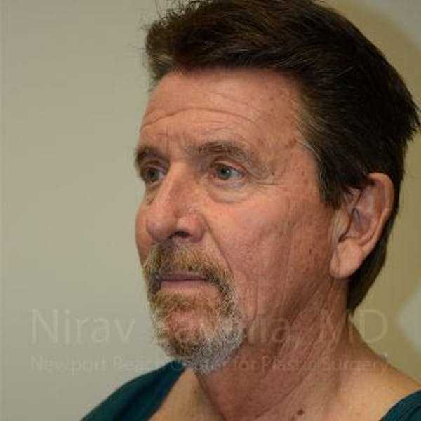 Facelift Before & After Gallery - Patient 1655726 - Before1