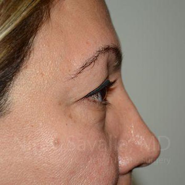 Eyelid Surgery Before & After Gallery - Patient 1655728 - Before1