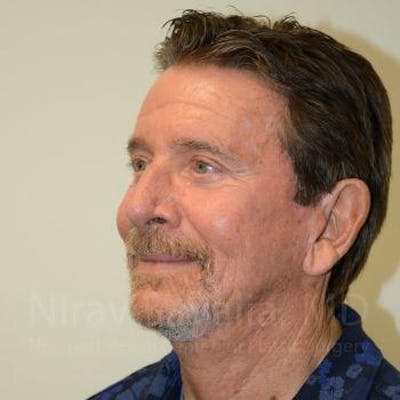 Facelift Before & After Gallery - Patient 1655726 - After1