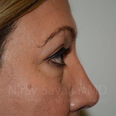 Eyelid Surgery Before & After Gallery - Patient 1655728 - After1