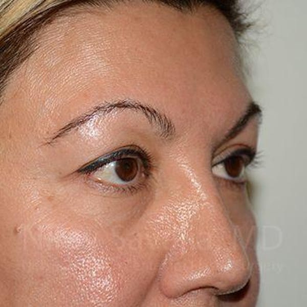 Eyelid Surgery Before & After Gallery - Patient 1655728 - Before1